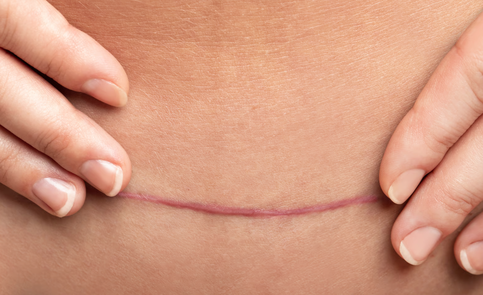 Tratar cicatrices de cesárea con fisioterapia
